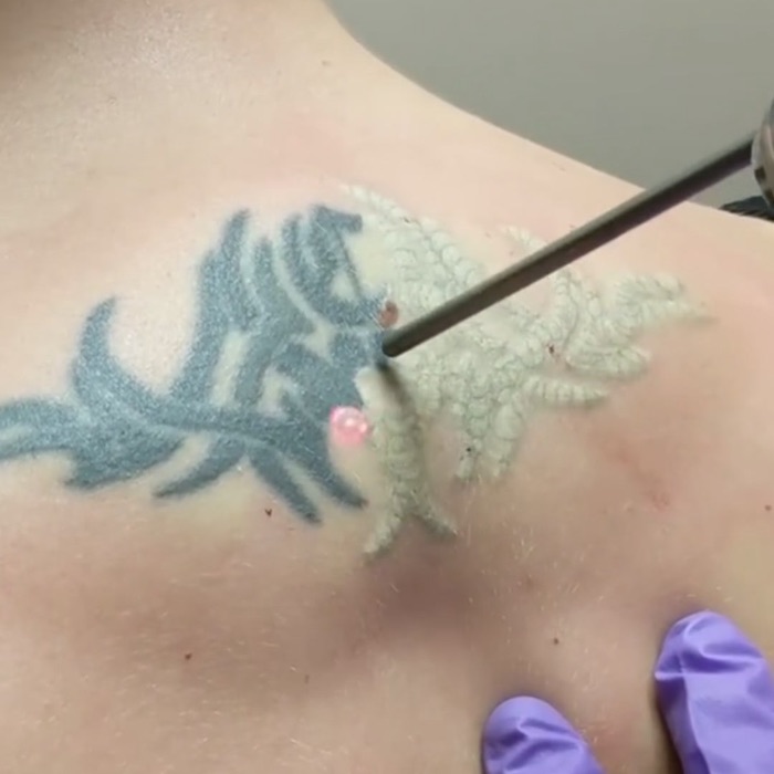 Tatueringen ljusnar direkt under laserbehandlingen