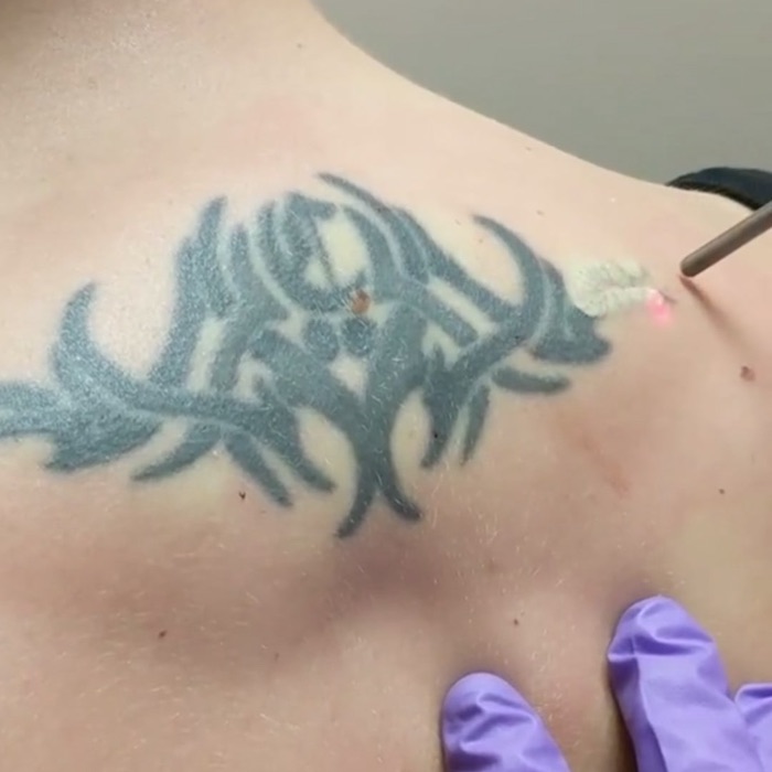 Laserbehandling av en tatuering på axeln